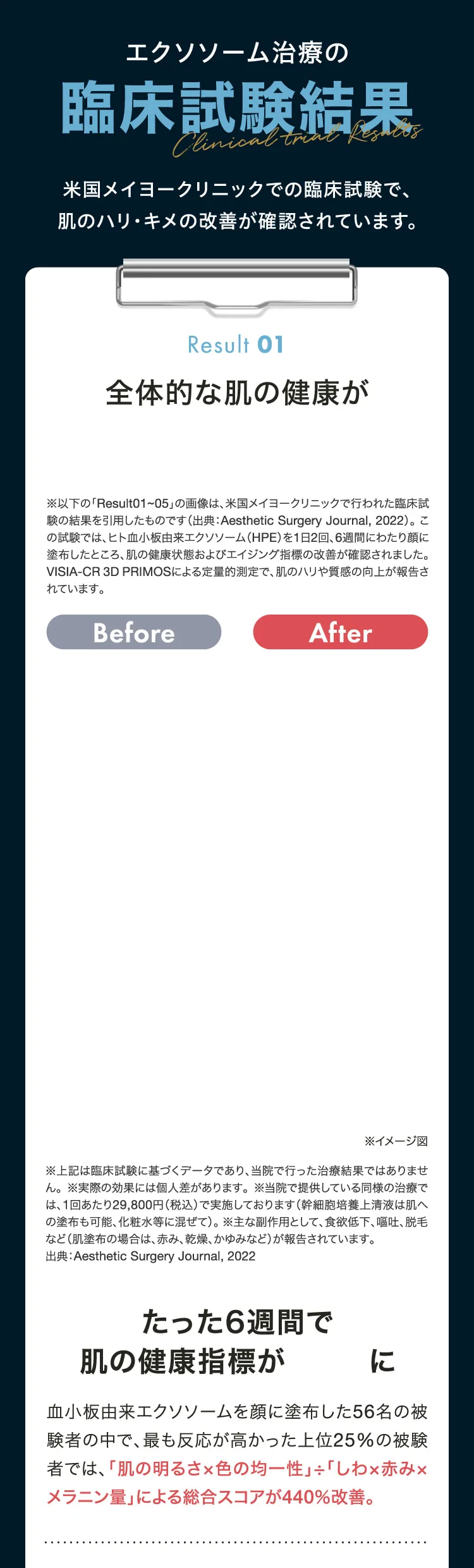 エクソソーム治療の臨床試験結果　Result01　血小板由来エクソソームを顔に塗布した56名の被験者の中で、最も反応が高かった上位25％の被験者では、「肌の明るさ×色の均一性」÷「しわ×赤み×メラニン量」による総合スコアが440％改善。