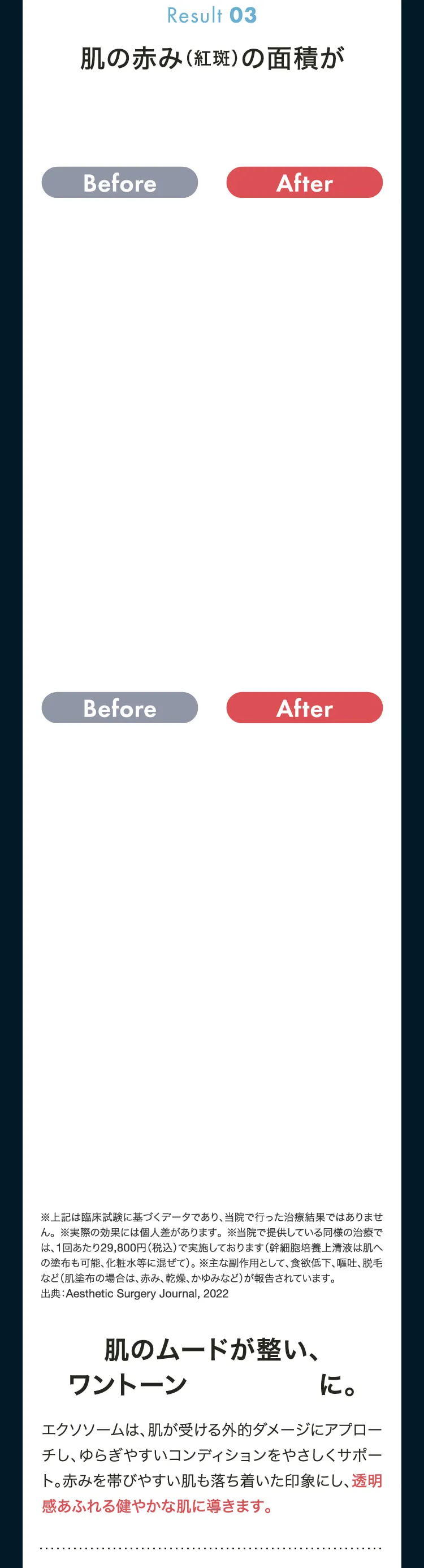Result03　エクソソームは、肌が受ける外的ダメージにアプローチし、ゆらぎやすいコンディションをやさしくサポート。赤みを帯びやすい肌も落ち着いた印象にし、透明感あふれる健やかな肌に導きます。