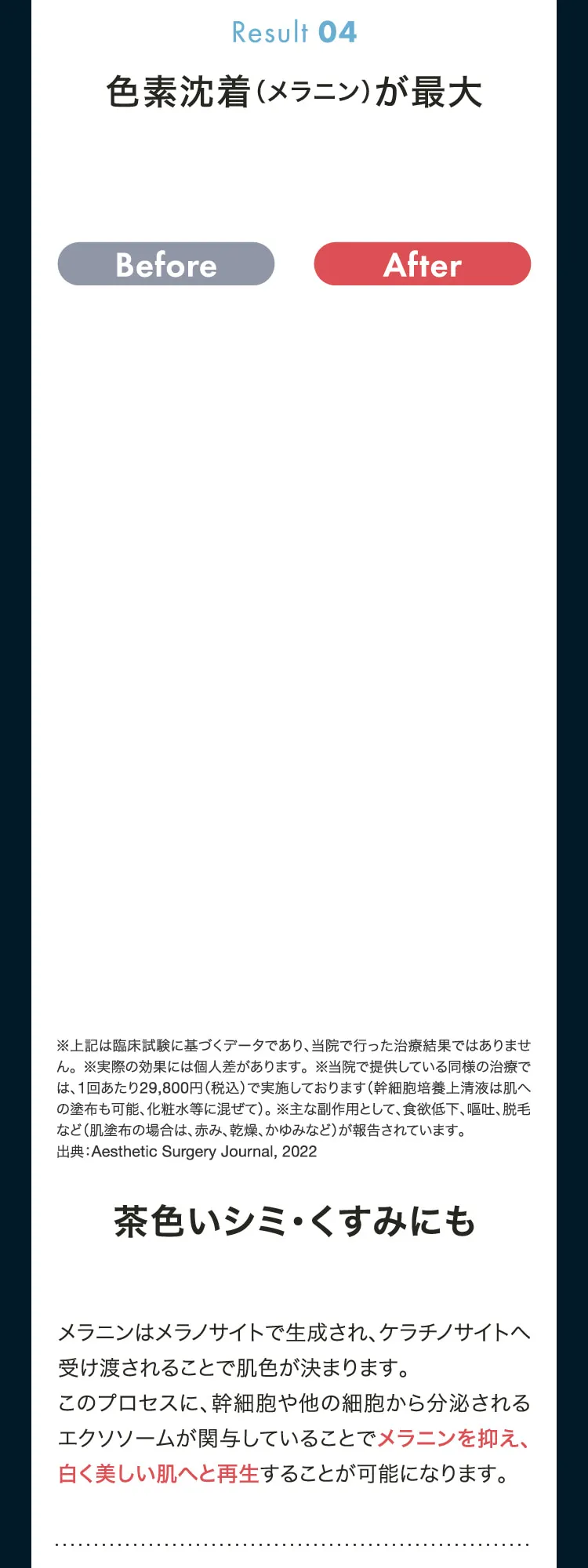 Result04　メラニンはメラノサイトで生成され、ケラチノサイトへ受け渡されることで肌色が決まります。このプロセスに、幹細胞や他の細胞から分泌されるエクソソームが関与していることでメラニンを抑え、白く美しい肌へと再生することが可能になります。